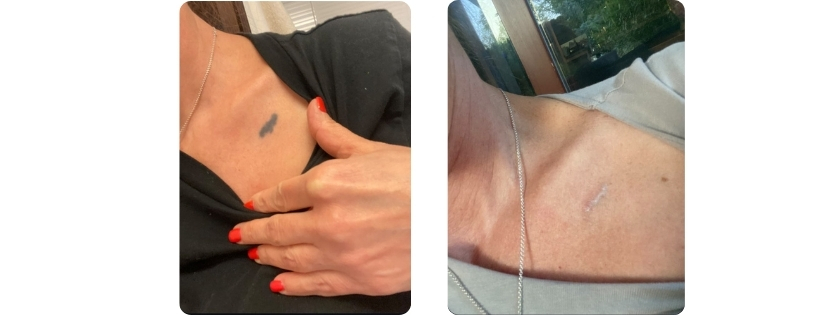 LaserTime Salontech eredmény képek