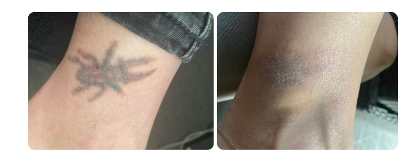 LaserTime Salontech eredmény képek
