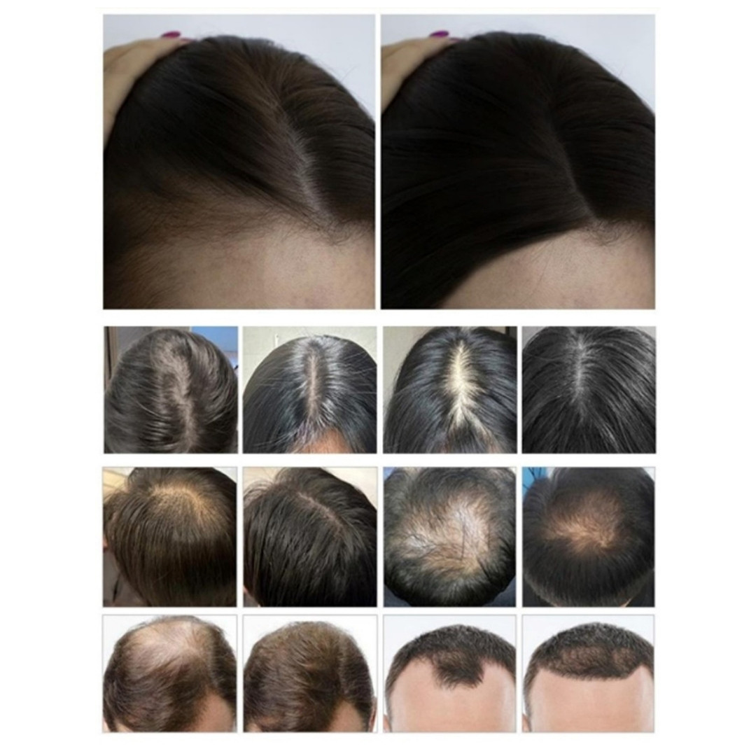 Eredmények kezelés után a SalonTech Hajnövesztő Kozmetikai Gép