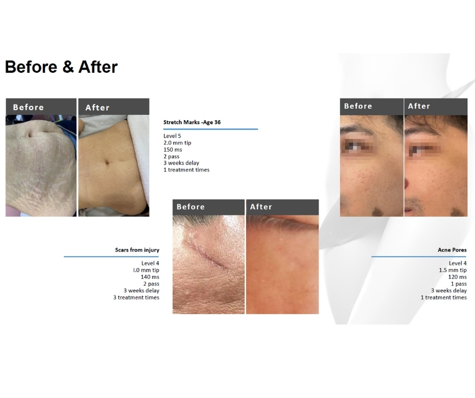 Eredmények a Dermiona Precision V-RF Vákuumos Mikrotűs Rádiófrekvenciás géppel