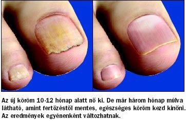 körömgomba gyógyszer tabletta nail eltávolítása folyadékot gomba